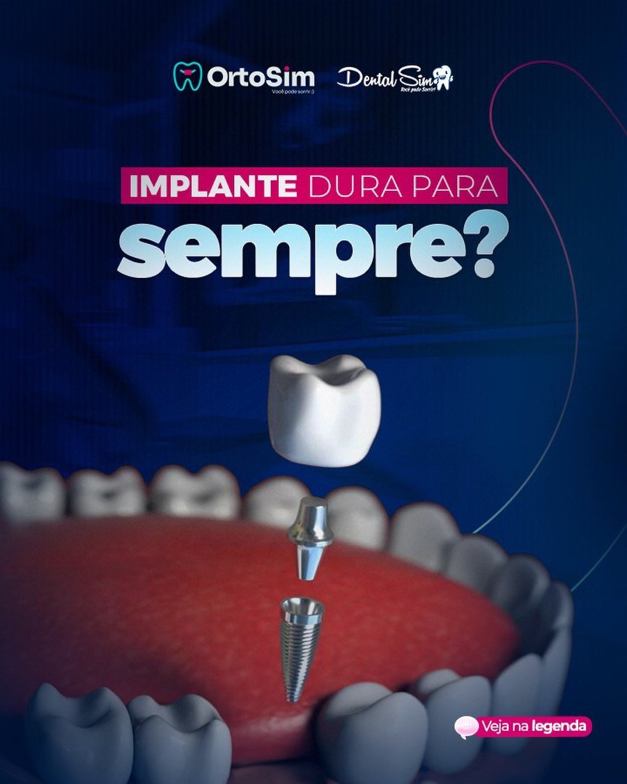 Implante dura para sempre?